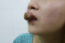 Môi cô gái trẻ biến thành "mỏ chim" sau khi xăm