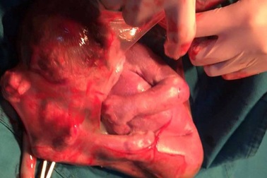 Nghệ An: Kinh ngạc bé gái chào đời còn nguyên túi ối