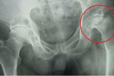 Hoại tử khớp háng khi tiêm corticoid chữa ngứa đầu