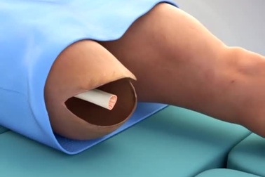 “Mục sở thị” kỹ thuật cấy ghép chân giả tiên tiến cho người tàn tật!