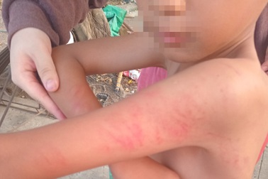 Học sinh lớp 1 ở Long An nghi bị cô giáo đánh sưng mặt, bầm người