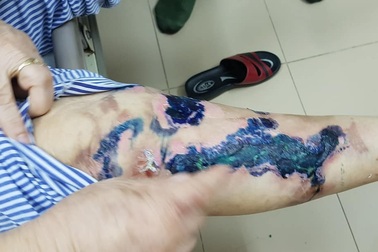 Gần 100% ca bỏng cồn do nướng mực, nướng cá