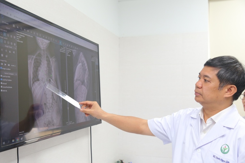 Điều cần chú ý để phát hiện trẻ bị vẹo cột sống trước 10 tuổi - 2 Điều cần chú ý để phát hiện trẻ bị vẹo cột sống trước 10 tuổi - 2