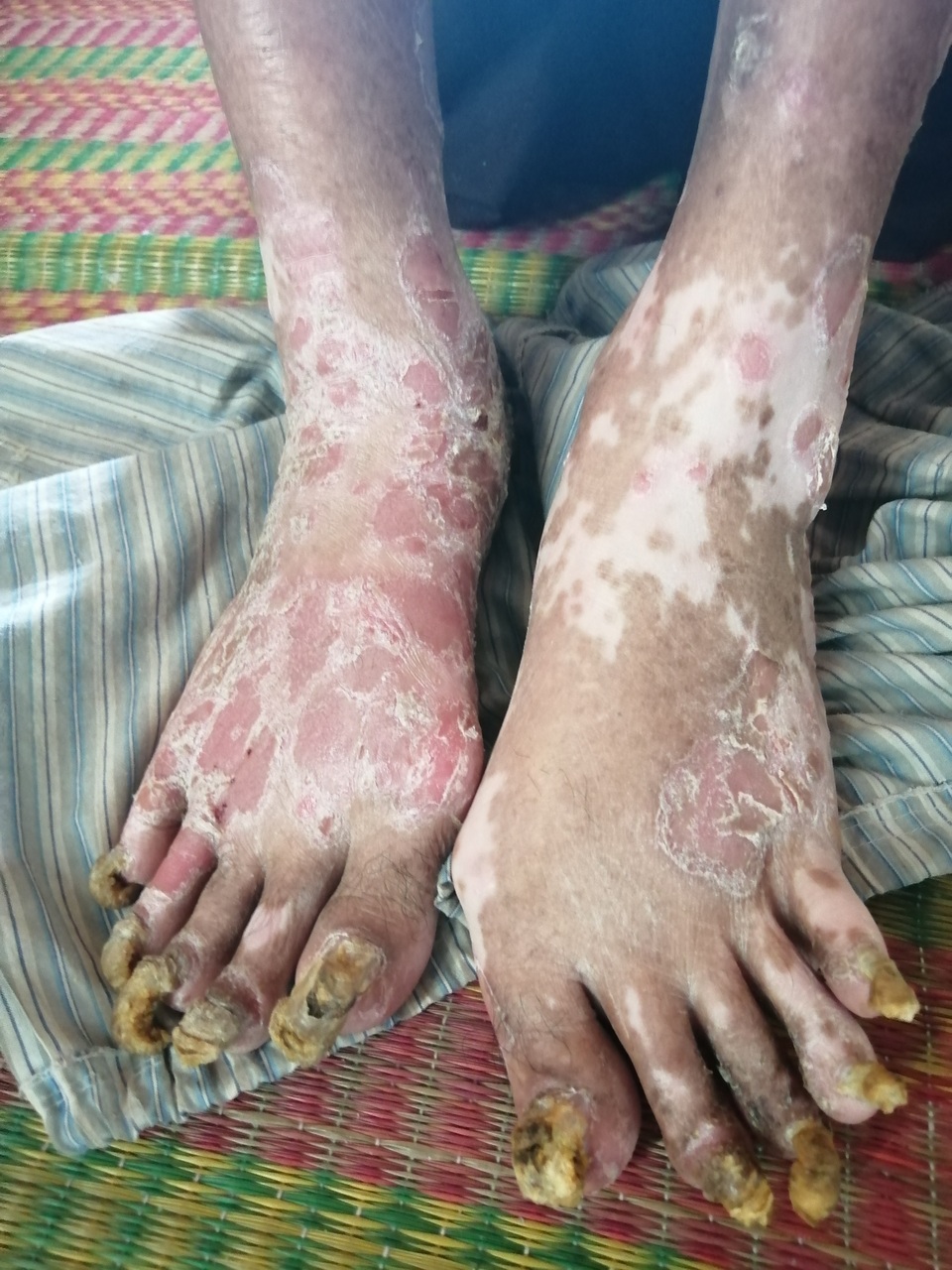 Sởn da gà cảnh người đàn ông vạm vỡ bị bệnh vảy nến quật ngã có bộ da như da cá sấu - 4 Sởn da gà cảnh người đàn ông vạm vỡ bị bệnh vảy nến quật ngã có bộ da như da cá sấu - 4