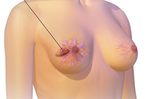 Nổi hạch nách- khi nào là dấu hiệu cảnh báo ung thư?