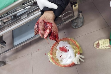 Nghịch pháo, 2 anh em bị thương nát tay, rách mặt