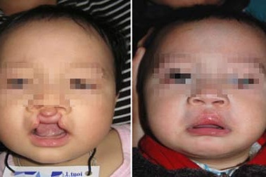 Lên bàn mổ, trẻ em đối mặt với nguy cơ nào?