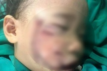 Nghệ An: Cháu bé 3 tuổi bị chó nhà cắn gây tổn thương nặng vùng mặt
