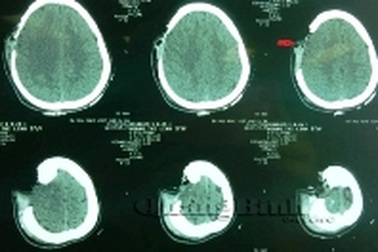 Chờ ghép lại, mảnh xương sọ được nuôi bằng bụng 