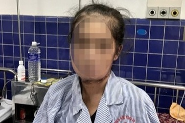 Phẫu thuật thành công cho nữ bệnh nhân bị ung thư lưỡi