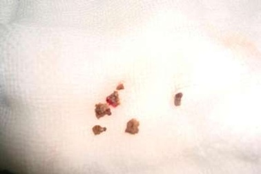 Lần đầu tiên tán sỏi bằng tia laze qua nội soi thành công