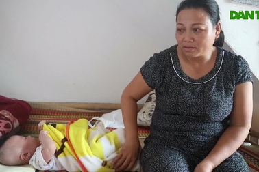 Bé 4 tháng tuổi mắc đa dị tật bẩm sinh