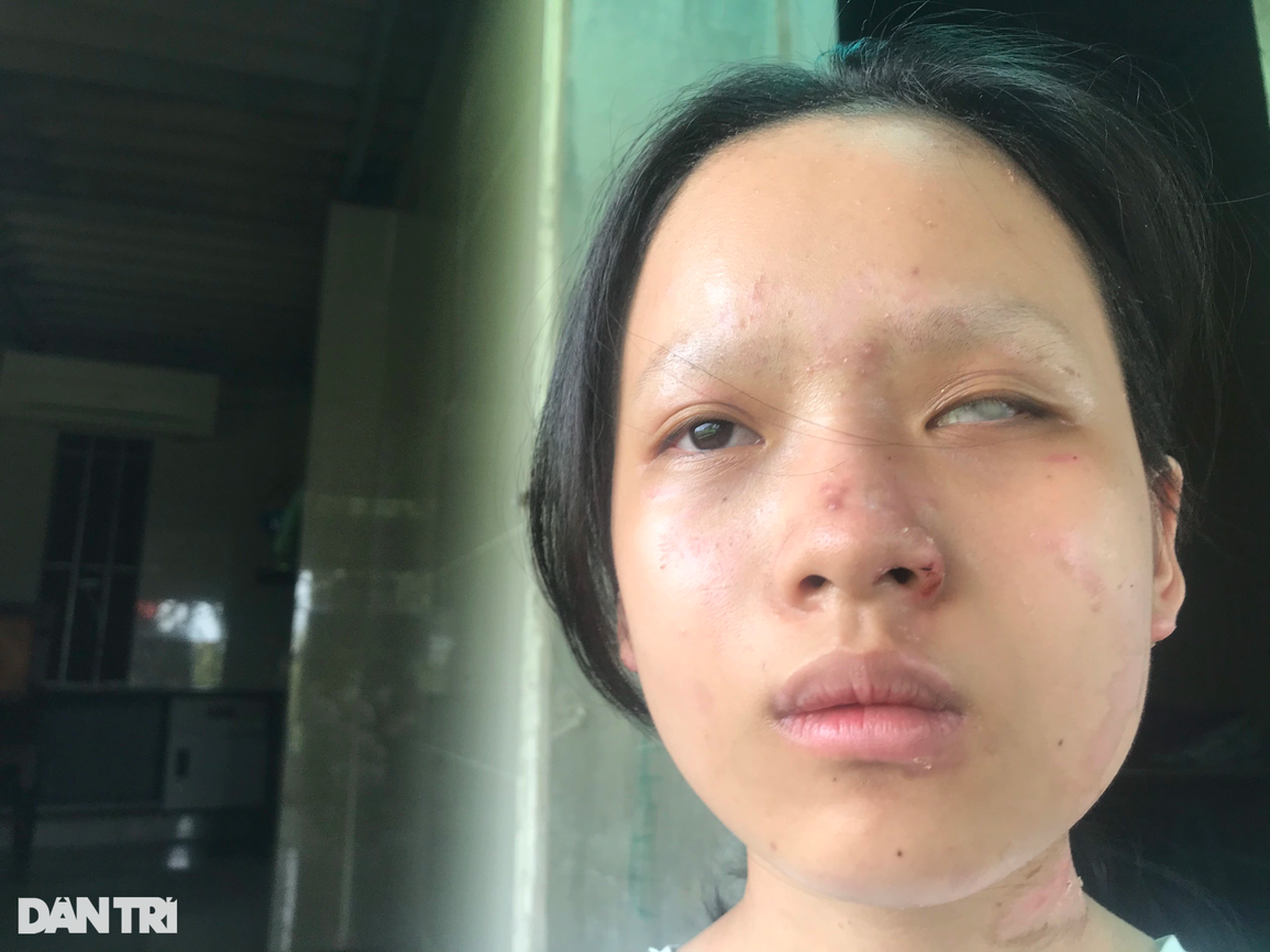 Cơ cực gia đình nghèo và tai họa đổ ập xuống 3 con nhỏ bị bỏng nặng - 1 Cơ cực gia đình nghèo và tai họa đổ ập xuống 3 con nhỏ bị bỏng nặng - 1