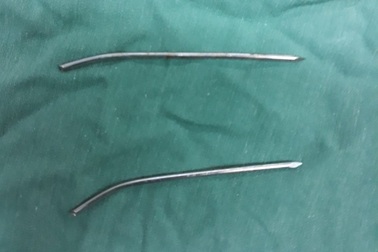 Cứu thành công bệnh nhân bị đinh đâm xuyên thực quản, khí quản