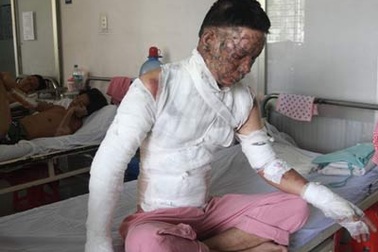 Hai vợ chồng bị bỏng cồn nước trong lúc ăn lẩu 