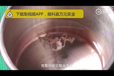 Sán dài 15 cm trong não bệnh nhân nữ