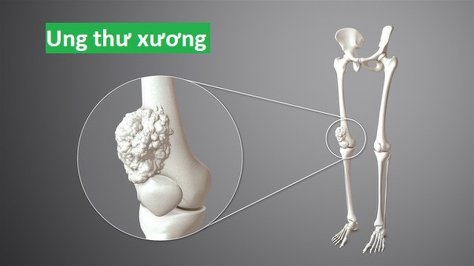 Chỉ điểm 3 loại ung thư thường gặp ở người trẻ tuổi - 2 Chỉ điểm 3 loại ung thư thường gặp ở người trẻ tuổi - 2