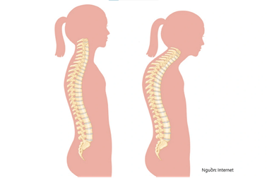 Điều trị gù vẹo cột sống kịp thời, bảo vệ tương lai cho trẻ