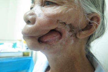 Phẫu thuật 9 giờ cứu cụ bà 73 tuổi mắc tổn thương phức tạp