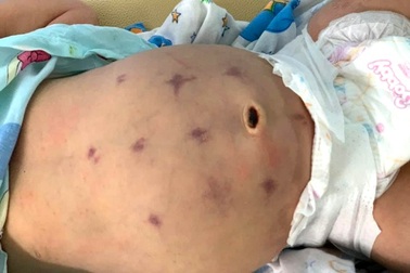 Bé sơ sinh bị cấu tím bụng… để “chữa” bệnh khó tiêu