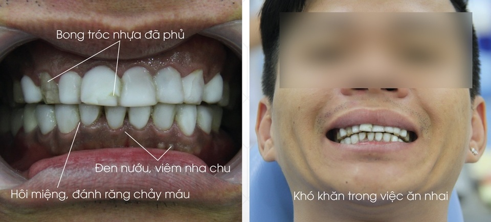 Nha khoa thẩm mỹ Dora Dental khắc phục hoàn toàn biến chứng do “Phủ Răng Sứ Nano” sai phương pháp - 1 Nha khoa thẩm mỹ Dora Dental khắc phục hoàn toàn biến chứng do “Phủ Răng Sứ Nano” sai phương pháp - 1