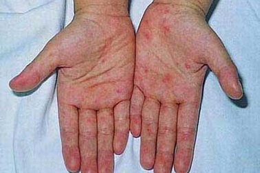 Công bố hướng dẫn mới điều trị bệnh tay chân miệng