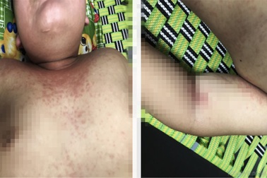 Bé trai nguy kịch vì căn bệnh xảy ra ngay sau khi vừa hết Covid-19