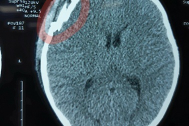 Bé 8 tuổi chấn thương sọ não vì bị đập chai bia vào đầu