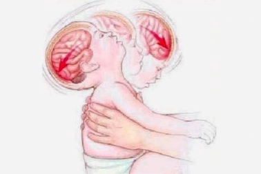 Bé 4 tháng tuổi bị xuất huyết não nghi do bế xốc, rung lắc