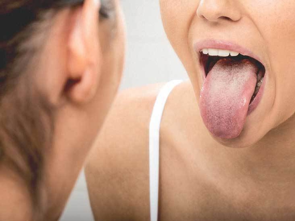 Ung thư lưỡi: Cách nhận biết và phòng ngừa hiệu quả - 1 Ung thư lưỡi: Cách nhận biết và phòng ngừa hiệu quả - 1