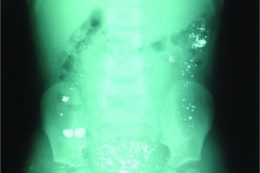 Nuốt phải thuỷ ngân trong nhiệt kế có nhiễm độc?