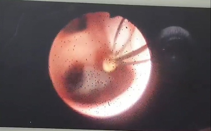 Kinh hãi hàng nghìn con sán lá gan làm tổ nhung nhúc trong đường mật người đàn ông, thói quen ăn uống này phải chấm dứt sớm! - Ảnh 1. Kinh hãi hàng nghìn con sán lá gan làm tổ nhung nhúc trong đường mật người đàn ông, thói quen ăn uống này phải chấm dứt sớm! - Ảnh 1.