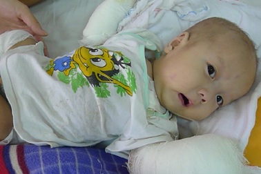 Tiếng khóc ngằn ngặt của bé 5 tháng tuổi bị li thượng bì bóng nước 