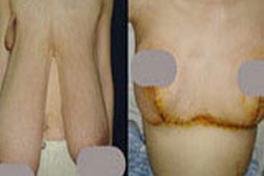 Bầu ngực nặng... 4kg