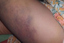 Nữ sinh bị giáo viên đánh bầm tím đùi tới mức phải lết từ bảng về chỗ ngồi?