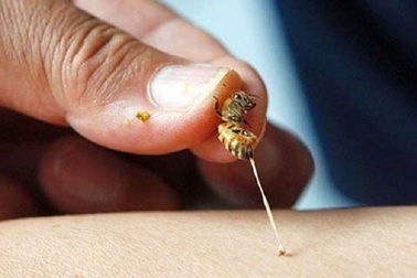 Suýt chết vì nhồi máu cơ tim cấp do một vết ong đốt