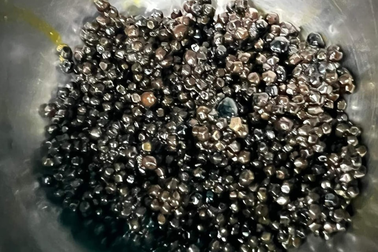 Cụ bà có hàng nghìn viên sỏi trong túi mật