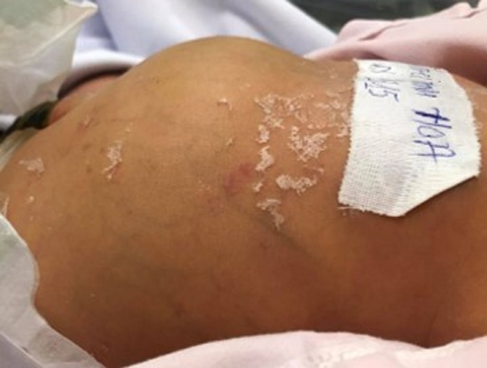 Vàng da sơ sinh ở trẻ, coi chừng bệnh lý nguy hiểm - 1 Vàng da sơ sinh ở trẻ, coi chừng bệnh lý nguy hiểm - 1