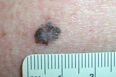 Nguy cơ ung thư da từ nốt ruồi