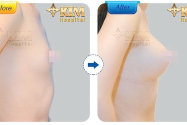Nâng ngực nội soi 3D: Những hệ lụy bạn cần biết
