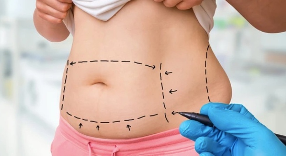 Gặp họa vì hút mỡ bụng, bà mẹ một con rớt nước mắt khi tỉnh lại sau cơn mê - 1 Gặp họa vì hút mỡ bụng, bà mẹ một con rớt nước mắt khi tỉnh lại sau cơn mê - 1
