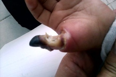 Bé trai mất ngón tay cái vì thọc vào ổ điện