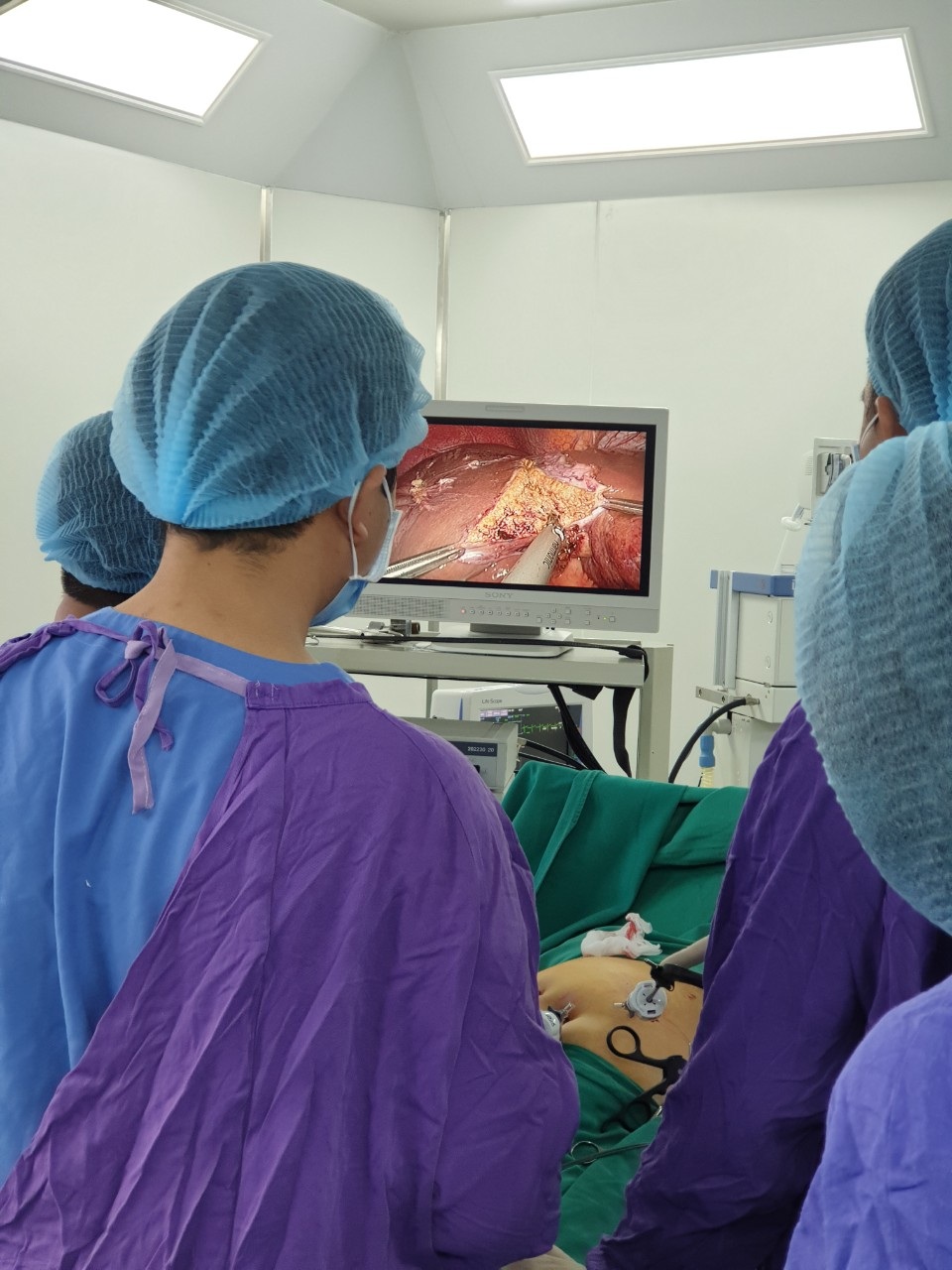 Thực hiện thành công kỹ thuật cắt gan nội soi cho bệnh nhân ung thư gan - 1