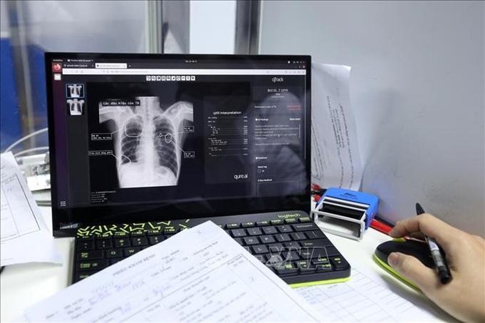 Xem X-quang được cài đặt phần mềm trí tuệ nhân tạo (AI) để nâng cao chất lượng đọc phim X-quang, góp phần tăng khả năng phát hiện bệnh lao. Ảnh minh họa: Minh Quyết/TTXVN