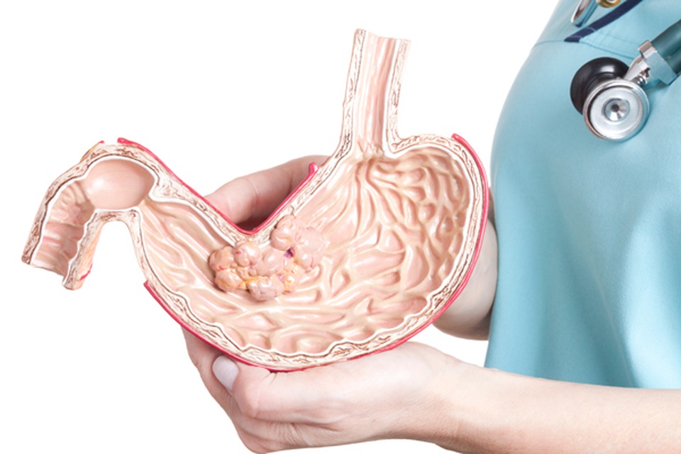 Có những triệu chứng này, ung thư dạ dày đã bước sang giai đoạn muộn - 2 Có những triệu chứng này, ung thư dạ dày đã bước sang giai đoạn muộn - 2