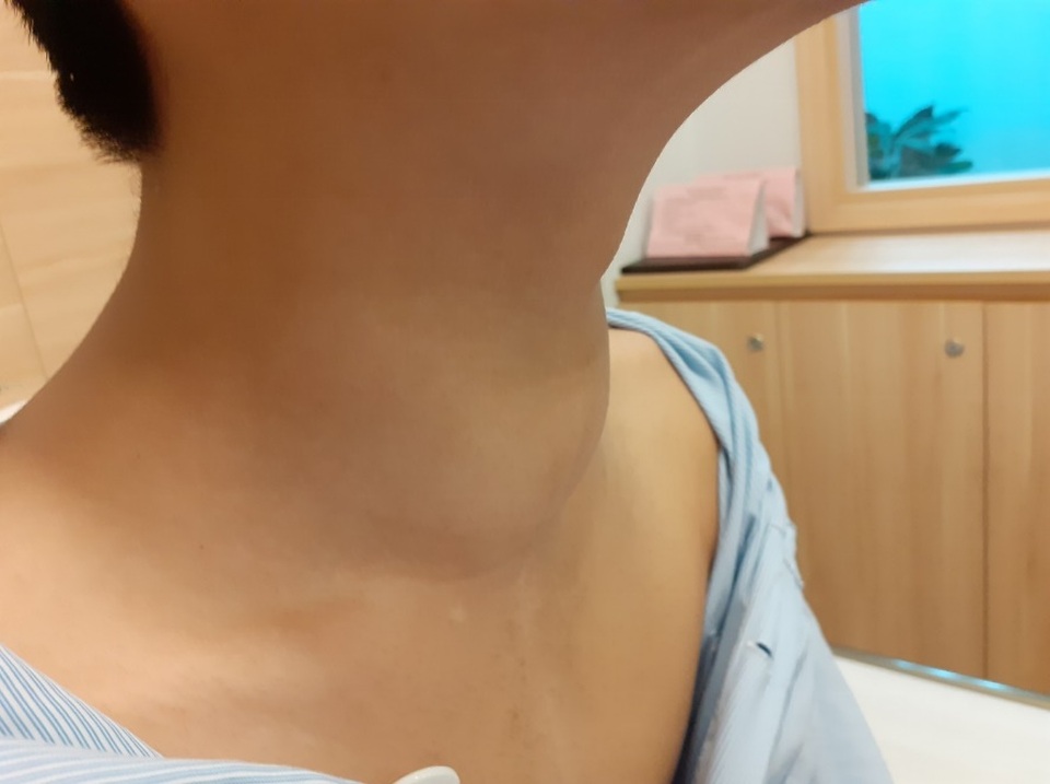 Cậu bé 15 tuổi nói khàn, khó thở như cá trên cạn vì u tuyến giáp di căn - 1 Cậu bé 15 tuổi nói khàn, khó thở như cá trên cạn vì u tuyến giáp di căn - 1