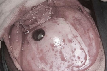 Nghịch súng tự chế, bé trai bị đạn bi bắn thấu sọ