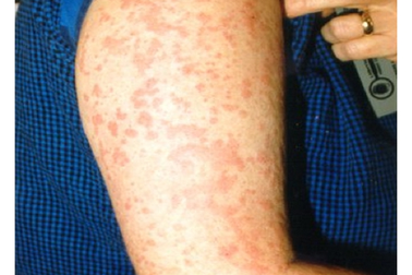 Da nổi ban, sốt kéo dài vì mắc bệnh hiếm gặp