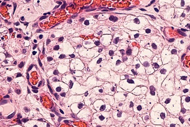 Có bao nhiêu loại ung thư?