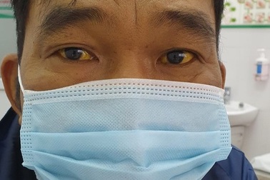 Tin lời "danh y", người đàn ông bị suy gan, da và mắt vàng như nghệ